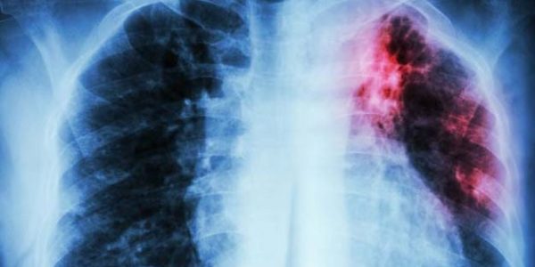 Undernutrition and the TB risk